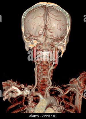 CTA cervello e arteria carotide o angiografia TC del cervello 3D immagine di rendering . Foto Stock