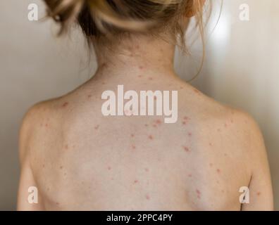 Varicella, virus della varicella o rash vescicolare sul corpo e sul viso della bambina. Primo piano sul retro di Kid con pimples rossi Foto Stock