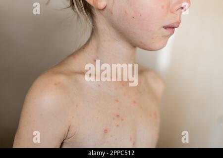 Varicella, virus della varicella o rash vescicolare sul corpo e sul viso della bambina. Primo piano Ritratto di Kid con pimples rosso. Volto oscurato del bambino Foto Stock