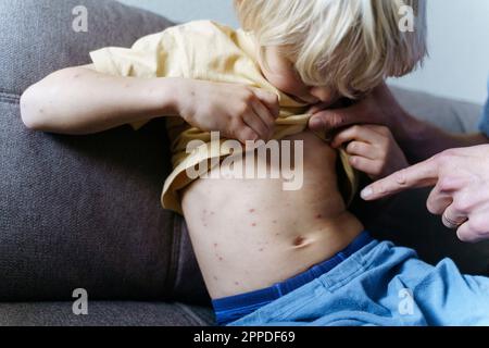 Padre puntando il dito e esaminando la varicella sul figlio a casa Foto Stock
