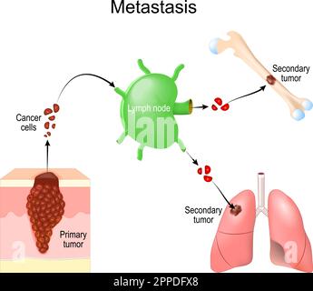 Metastasi. Le cellule tumorali del tumore primario sopravvivono nel linfonodo e si diffondono ad altri organi. invasione del cancro. tumore maligno. illustrazione vettoriale Illustrazione Vettoriale