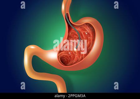 Endoscopia digestiva o gastroscopia. Esecuzione di una procedura di gastroscopia. Diagnostica di malattie gastriche. Salute dello stomaco. Foto Stock