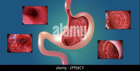 Mucosa gastrica. Endoscopia digestiva o gastroscopia. Esecuzione di una procedura di gastroscopia. Diagnostica di malattie gastriche. Salute dello stomaco. Foto Stock