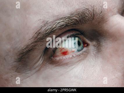 EE di un uomo con un vaso di scoppio nel bulbo oculare. Emorragia nell'occhio Foto Stock