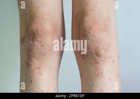 Eruzione cutanea rossa ragazza malattia della pelle causata da allergie a farmaci, cibo, prodotti chimici, sistema immunitario povero nella linfa. Foto Stock