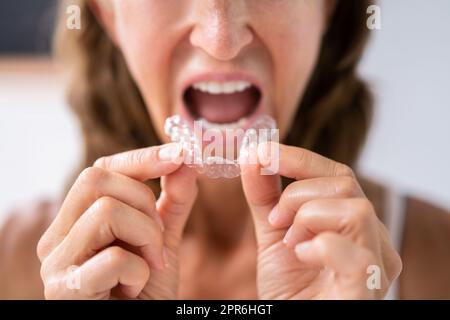 Guardia notturna dentale Aligner trasparente Foto Stock