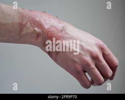 Primo piano della mano di una donna con un blister scoppiato da un'ustione di acqua bollita, pelle rotta, 1st o 2nd gradi. Ferita dolorosa. Bruciatura termica. Bucce della pelle Foto Stock