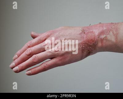 Primo piano della mano di una donna con un blister scoppiato da un'ustione di acqua bollita, pelle rotta, 1st o 2nd gradi. Ferita dolorosa. Bruciatura termica. Bucce della pelle Foto Stock