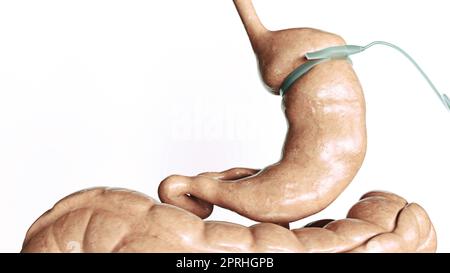 Riduzione dello stomaco 3 di 4- - banda gastrica regolabile - AGB -- rendering 3D Foto Stock