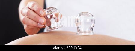 Cupping Therapy usando il vetro cinese vuoto. Tazza di massaggio Foto Stock