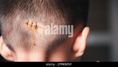 La ferita suturata lacerata della testa posteriore del capretto che sutura con sutura di nylon circa 3 punti al pronto soccorso dell'ospedale, cura medica del Foto Stock