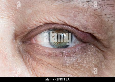 occhio maschio infiammato con calazio sulla palpebra da vicino Foto Stock