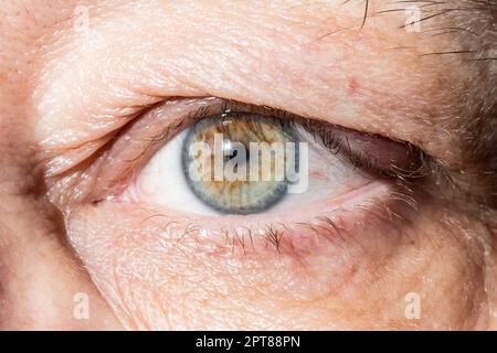 occhio irritato con ispessimento sulla palpebra da primo piano calazio Foto Stock