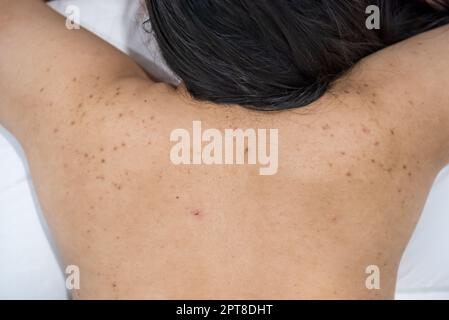 L'acne sulla parte posteriore della donna di cura della pelle è causata dai batteri. Foto Stock