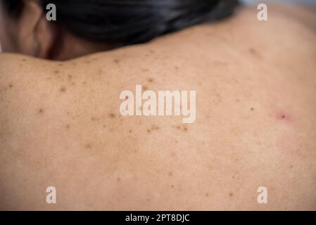 L'acne sulla parte posteriore della donna di cura della pelle è causata dai batteri. Foto Stock