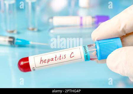 Il medico tiene una provetta per il campione di sangue con test HCV del virus dell'epatite C sullo sfondo delle provette per test medici. Banner. Foto Stock