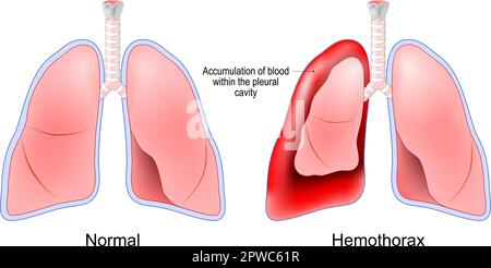 Emotorace. Polmoni umani sani e polmoni rossi dopo l'accumulo di sangue all'interno della cavità pleurica. Trauma toracico. trattamento dell'embolia polmonare Illustrazione Vettoriale