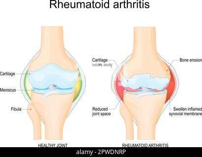Artrite reumatoide. Un confronto tra un ginocchio sano e l'articolazione con erosione ossea, usura cartilaginea, ridotto spazio articolare Illustrazione Vettoriale