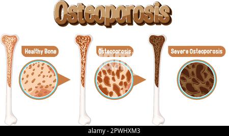 Illustrazione del confronto tra osso normale e osso e osteoporosi Illustrazione Vettoriale