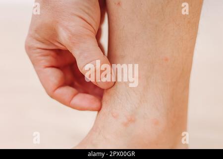 Primo piano l'uomo che graffia con eruzione cutanea allergica alla mano sulla gamba. Gamba con eruzione cutanea rossa causata da punture di insetti. Dermatite, follicolite, infezione fungina. Interessato Foto Stock