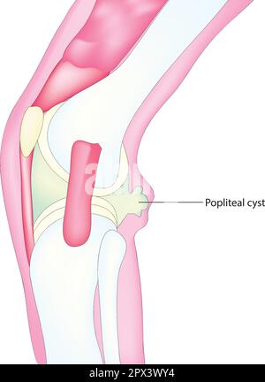 Cisti poplitea Illustrazione Vettoriale