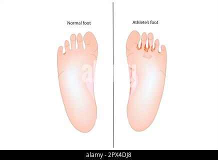 Piede dell'atleta Illustrazione Vettoriale
