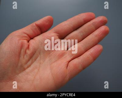 Mano femminile con pelle atopica secca. Sfondo bianco. Primo piano della pelle sul palmo e sulle dita. Problemi dermatologici. Predica la fortuna per le linee sulla mano, palmistry Foto Stock