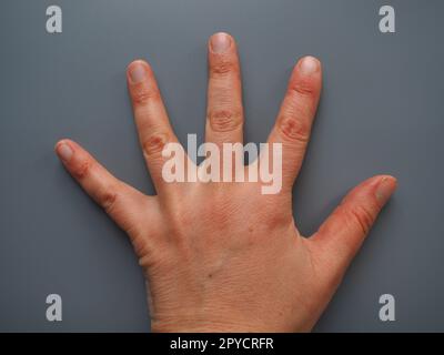 Allargare 5 dita. Mano femminile con pelle atopica secca. Sfondo bianco. Primo piano della pelle sul palmo e sulle dita. Derma che ha bisogno di cure e idratazione. Problemi dermatologici. Sfondo grigio. Foto Stock