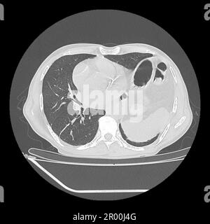 Ernia iatale, scansione TC Foto Stock