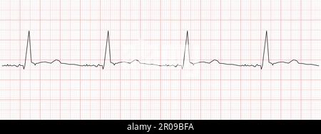 Diagramma del battito cardiaco nero su carta con grafico rosso. Esempio di grafico dell'elettrocardiogramma. Linea del ritmo cardiaco. Segnale test cardio. Simbolo dell'ospedale cardiologico Illustrazione Vettoriale