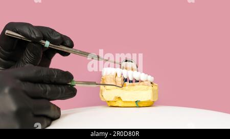 Mano del dentista che tiene il modello di intonaco smontabile di lavoro su fondo rosa. Impiallacciatura e corone su modello in gesso a ganascia inferiore con denti preparati. Bianco Foto Stock