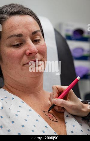 Il dermatologo consulta il paziente dopo aver disegnato il torace di una giovane donna di 30s anni per la procedura di escissione del carcinoma basocellulare. Foto Stock