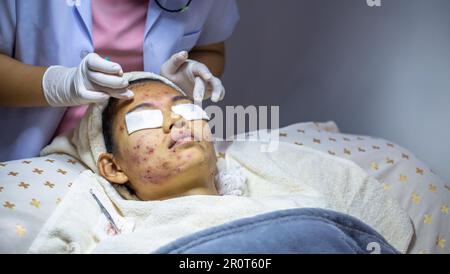 Il problema dell'acne sul viso infiammazione della pelle. Il concetto di bellezza nelle donne. I disturbi della pelle portano alla depressione e all'insicurezza nelle donne. Foto Stock
