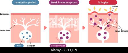 Illustrazione vettoriale del meccanismo delle herpes zoster Illustrazione Vettoriale