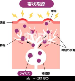 Illustrazione vettoriale del meccanismo delle herpes zoster Illustrazione Vettoriale