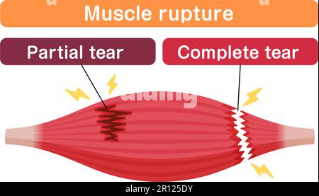 Illustrazione del vettore di rottura muscolare (lacrime parziali e complete ) Illustrazione Vettoriale