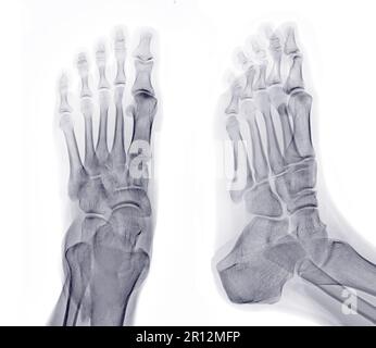 Immagine radiografica del piede vista AP e obliqua isolata su sfondo bianco. Foto Stock