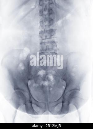 Immagine radiografica della colonna lombare o della vista laterale della colonna vertebrale L-s per la diagnosi del mal di schiena inferiore. Foto Stock