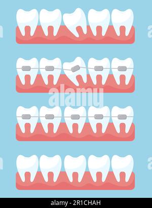 Set denti con bretelle ortodontiche Illustrazione Vettoriale