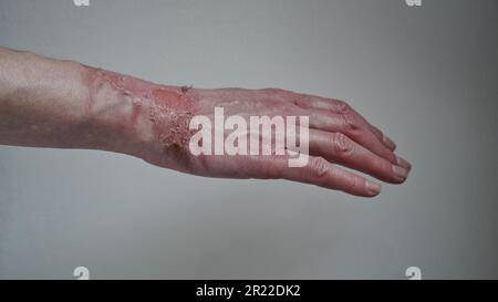 Primo piano della mano di una donna con un blister scoppiato da un'ustione di acqua bollita, pelle rotta, 1st o 2nd gradi. Ferita dolorosa. Bruciatura termica. Bucce della pelle Foto Stock