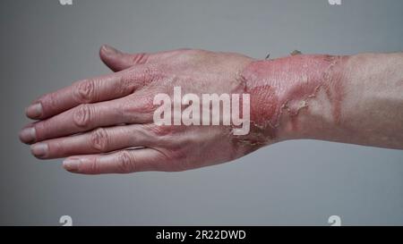 Primo piano della mano di una donna con un blister scoppiato da un'ustione di acqua bollita, pelle rotta, 1st o 2nd gradi. Ferita dolorosa. Bruciatura termica. Bucce della pelle Foto Stock