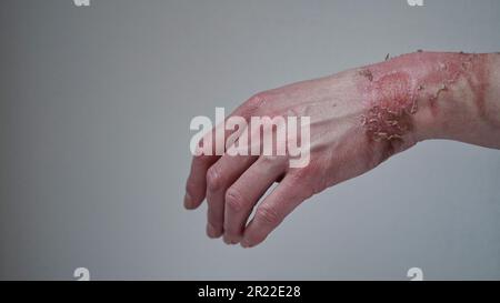 Primo piano della mano di una donna con un blister scoppiato da un'ustione di acqua bollita, pelle rotta, 1st o 2nd gradi. Ferita dolorosa. Bruciatura termica. Bucce della pelle Foto Stock