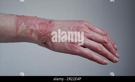 Primo piano della mano di una donna con un blister scoppiato da un'ustione di acqua bollita, pelle rotta, 1st o 2nd gradi. Ferita dolorosa. Bruciatura termica. Bucce della pelle Foto Stock