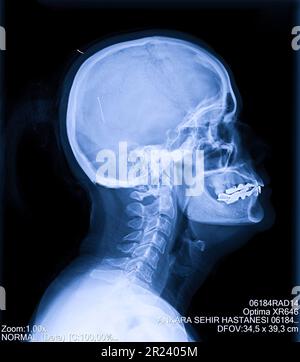 Radiografia della colonna cervicale umana, del collo Foto Stock