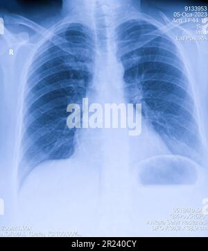 Immagine a raggi X del torace dell'uomo per una diagnosi medica Foto Stock