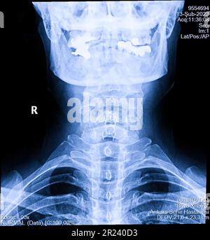 Radiografia della colonna cervicale umana, del collo Foto Stock