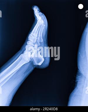 X-ray umano normale il piede laterale Foto Stock