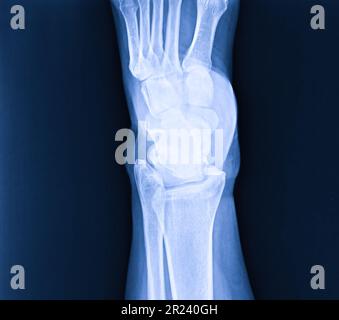 X-ray umano normale il piede laterale Foto Stock