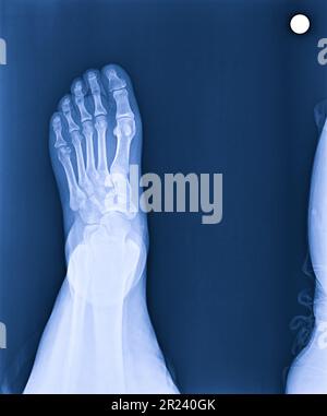 X-ray umano normale il piede laterale Foto Stock