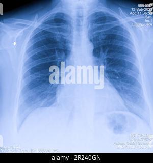 Immagine a raggi X del torace dell'uomo per una diagnosi medica Foto Stock